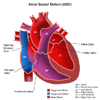 Congenital Heart Disease | Spectrum Health Lakeland