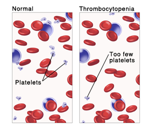 Thrombocytopenia | Spectrum Health Lakeland