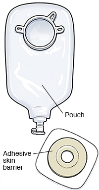 Two-piece drainable urostomy pouch.