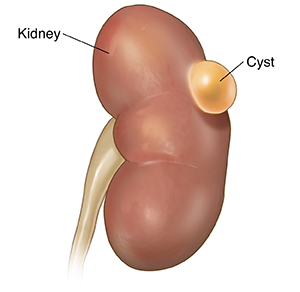 Kidney cysts