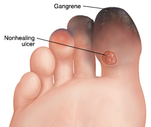 Sole of foot showing nonhealing ulcer on big toe and gangrene on first three toes.