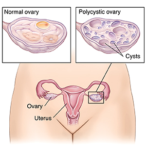 When Your Teenager Has Polycystic Ovary Syndrome (PCOS) | Spectrum Health  Lakeland