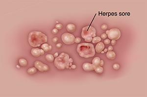 Herpes of genital Genital herpes