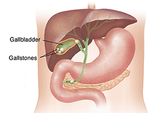 Gallbladder stone