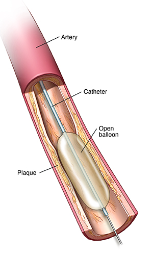 Angioplasty and Stent Placement for the Heart | Spectrum Health Lakeland