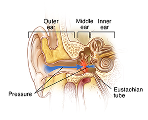 Front view cross section of outer, middle, and inner ear showing pressure on both sides of eardrum.