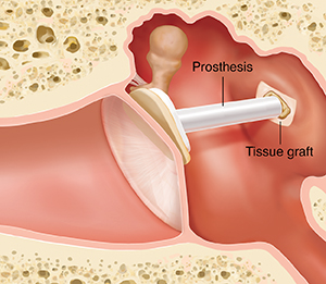 Cross section of ear showing outer, inner, and middle ear structures with prosthesis and tissue graft.