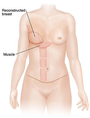 Breast Reconstruction with Flap Procedures