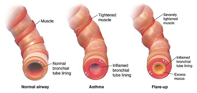 Your Child's Asthma: Flare-ups